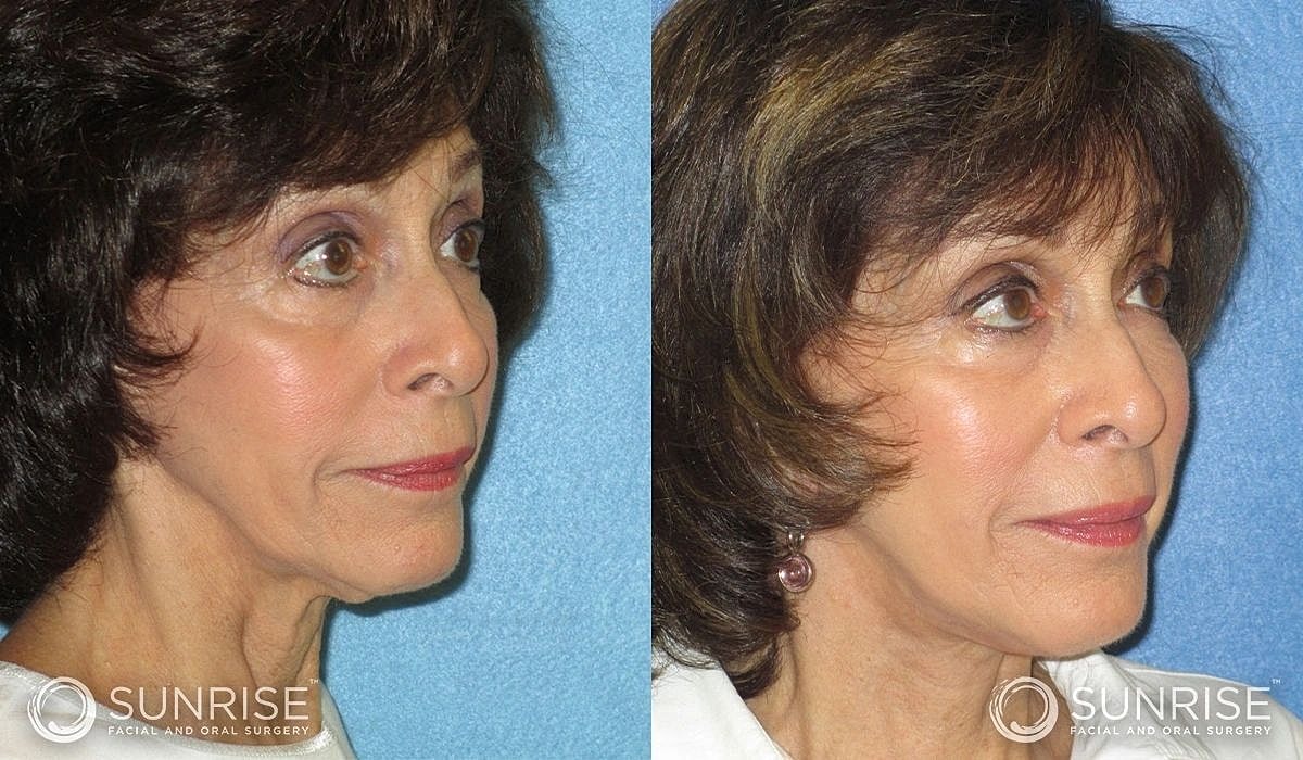 Necklift Before & After