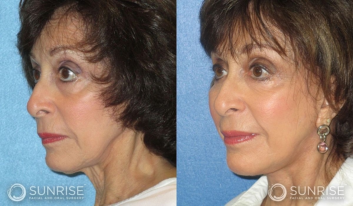 Necklift Before & After