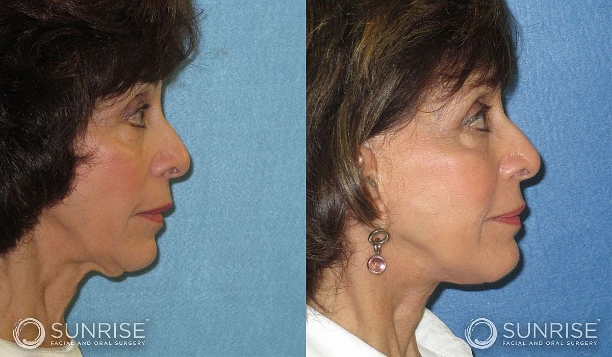 Necklift Before & After