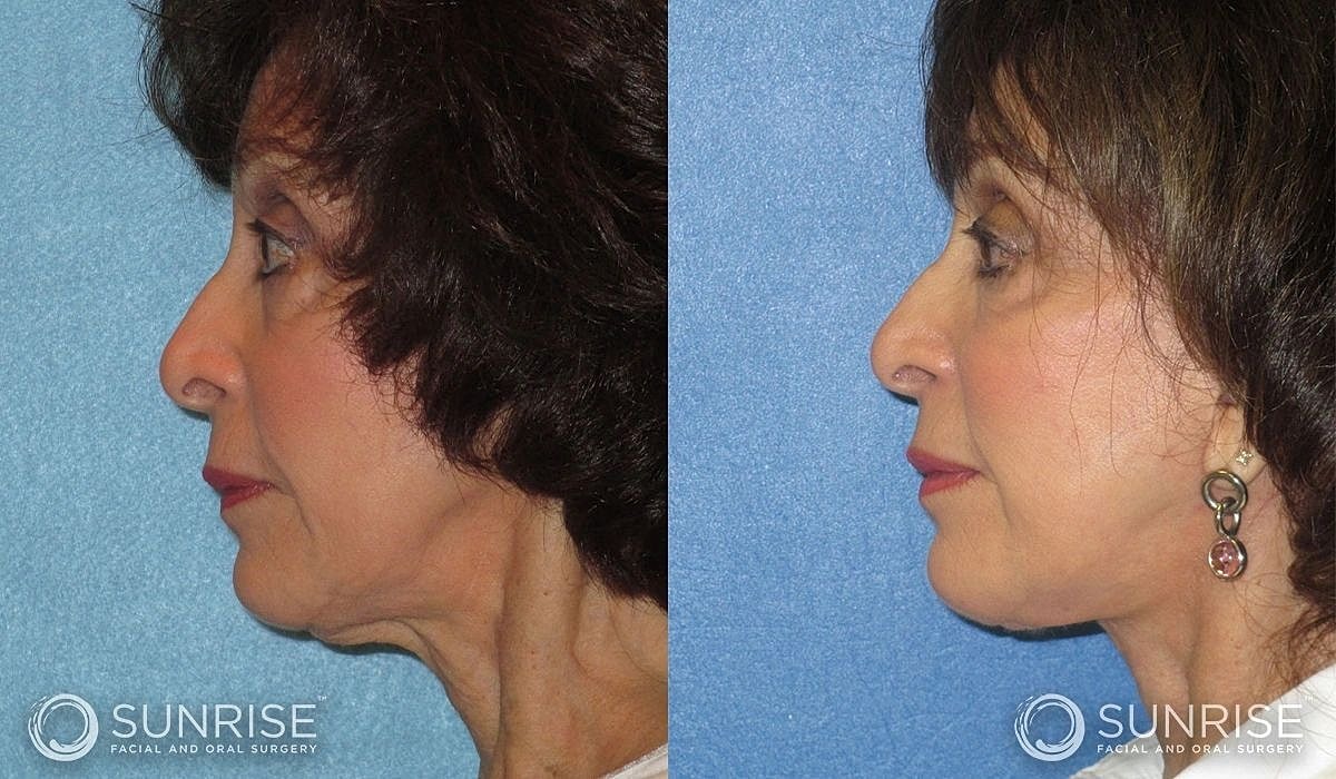 Necklift Before & After