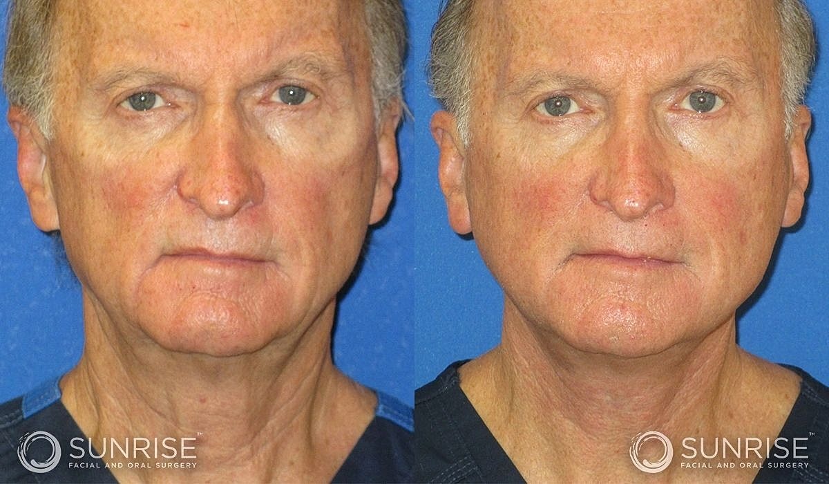 Necklift Before & After