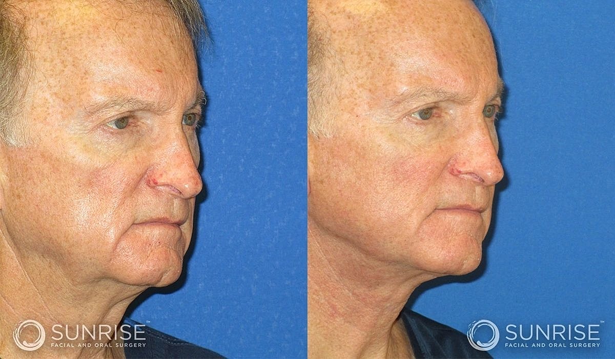 Necklift Before & After