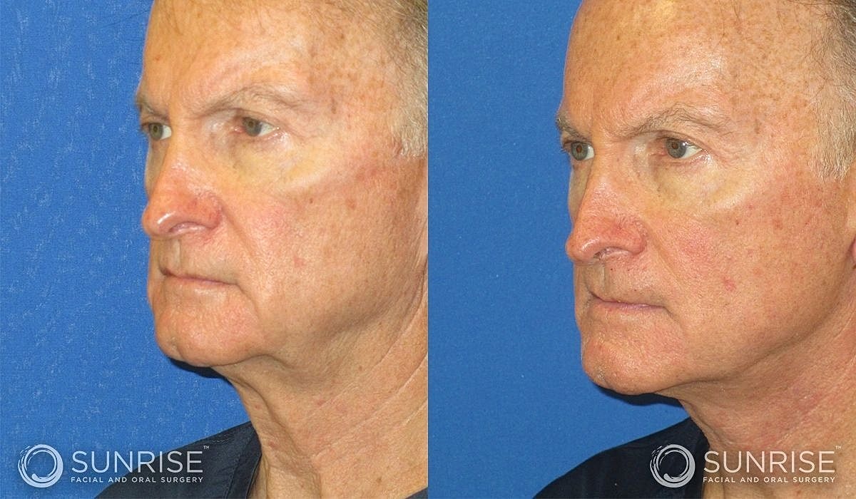 Necklift Before & After