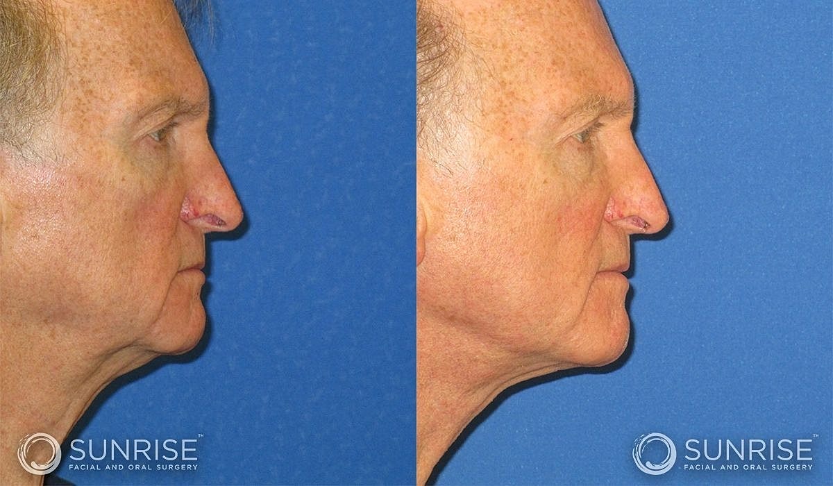 Necklift Before & After