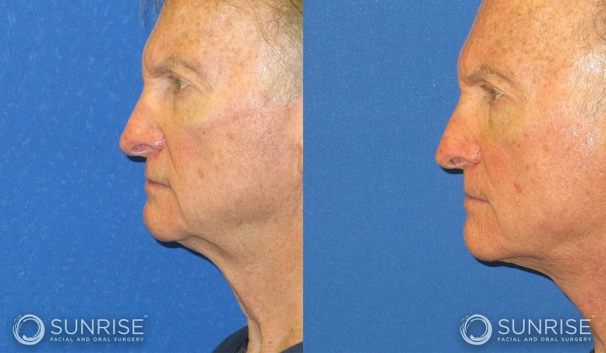 Necklift Before & After
