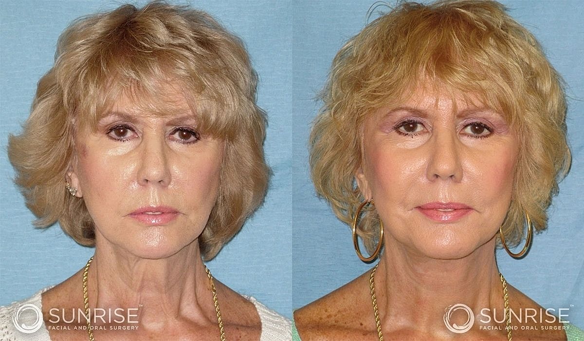 Necklift Before & After