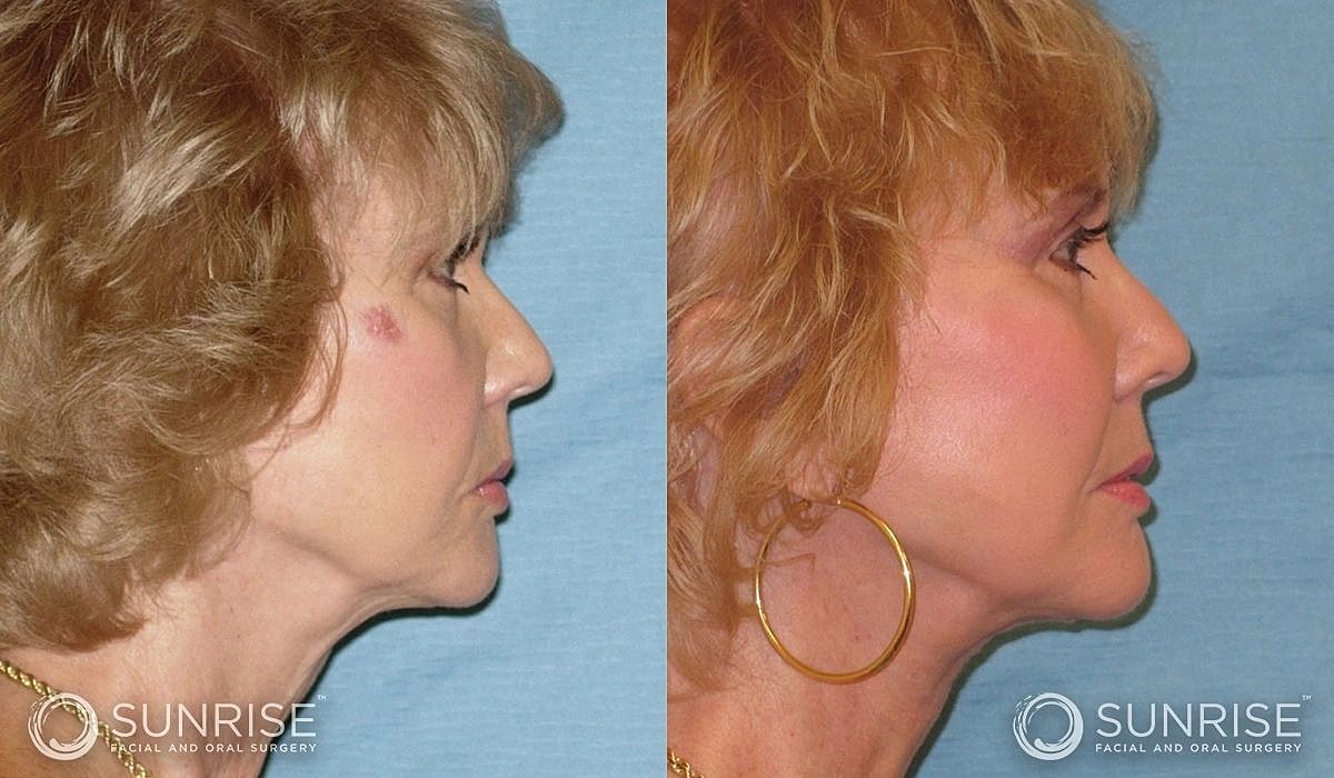 Necklift Before & After