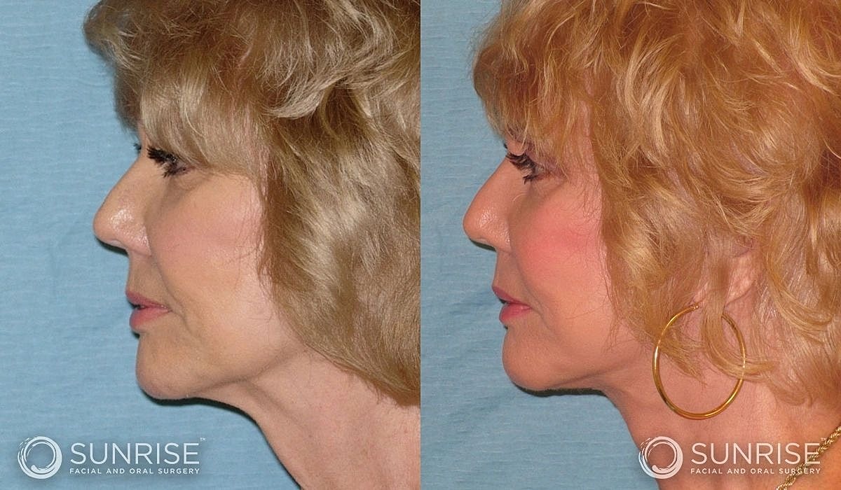 Necklift Before & After