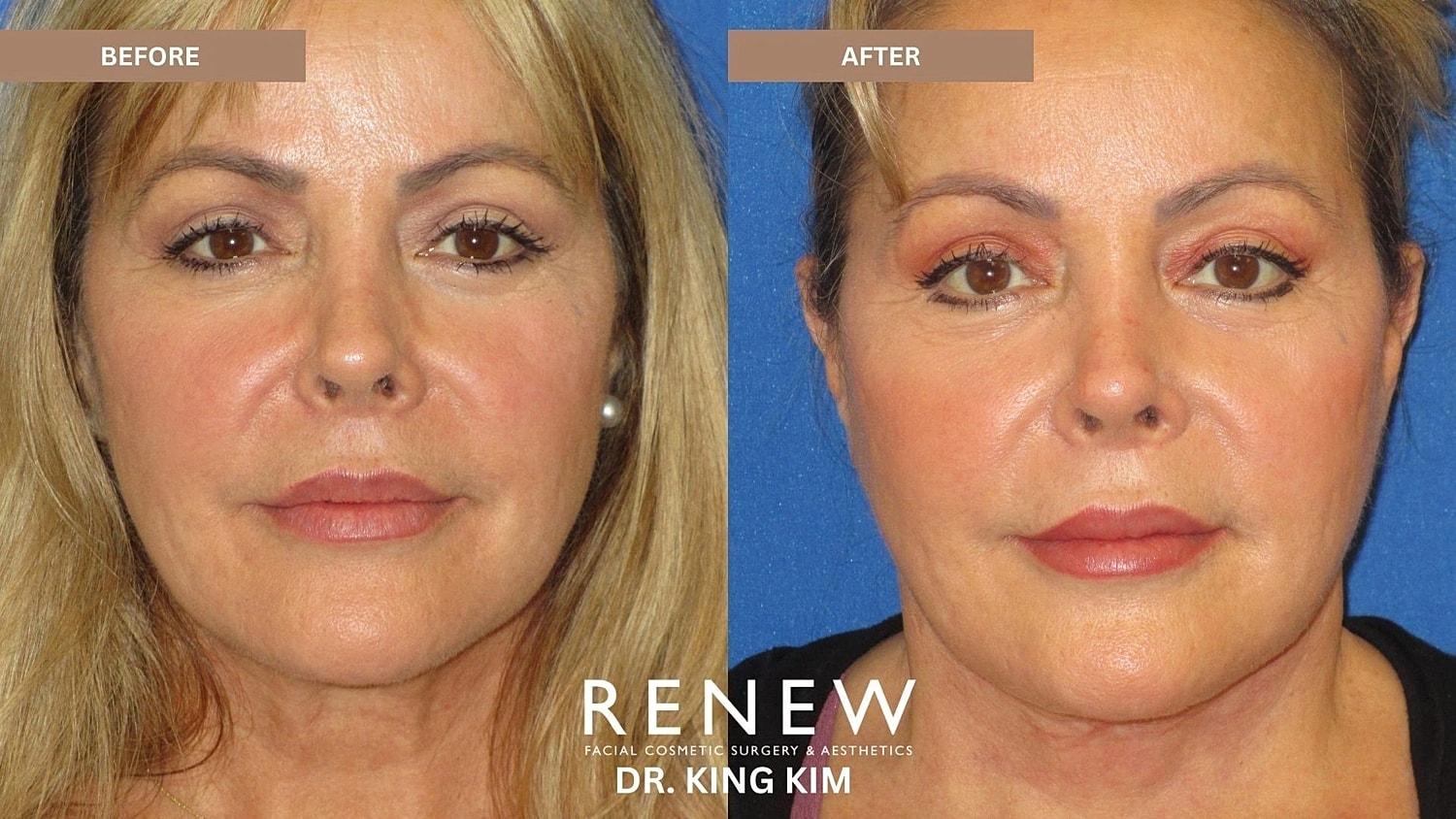 Necklift Before & After