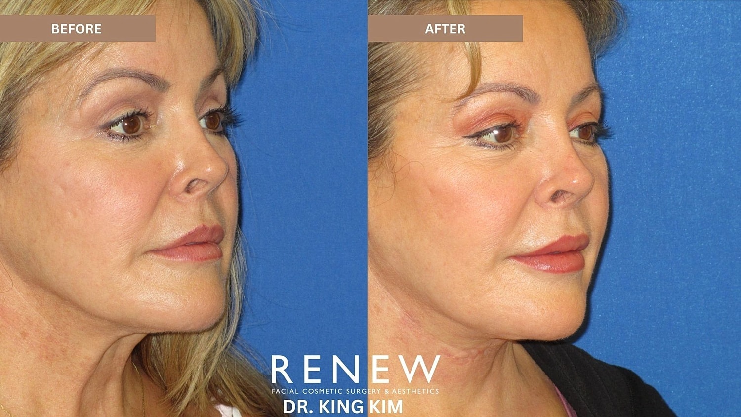 Necklift Before & After