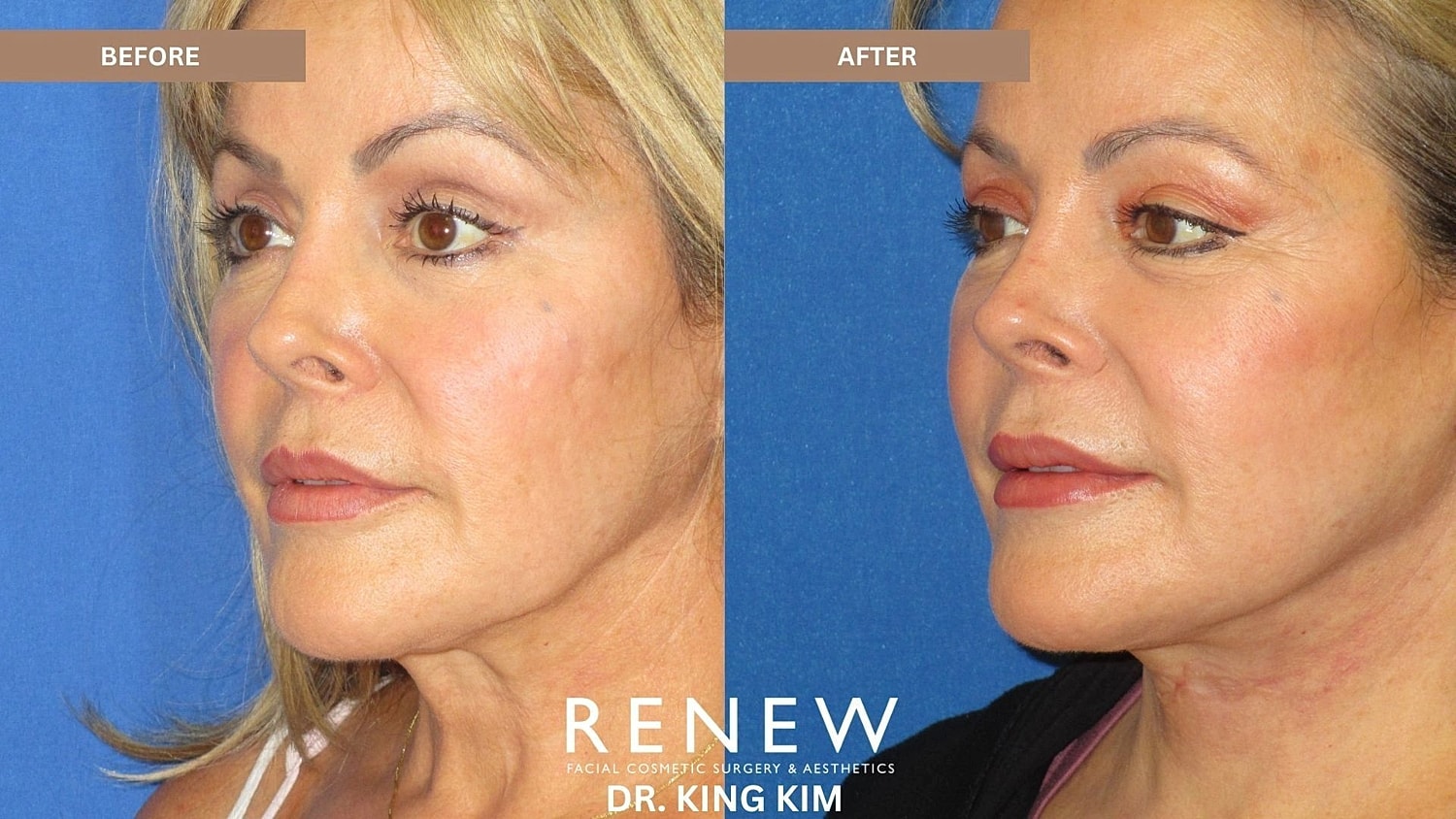 Necklift Before & After