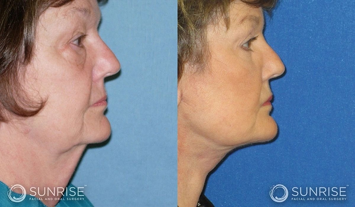Necklift Before & After