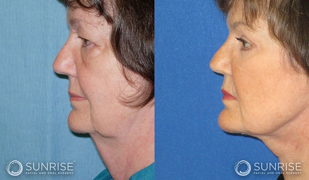 Necklift Before & After