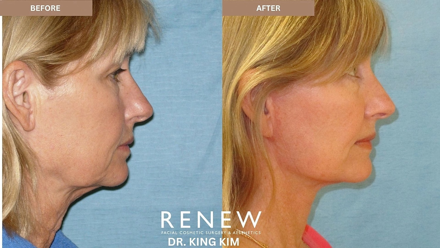 Necklift Before & After