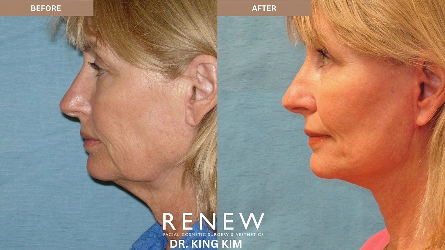 Necklift Before & After