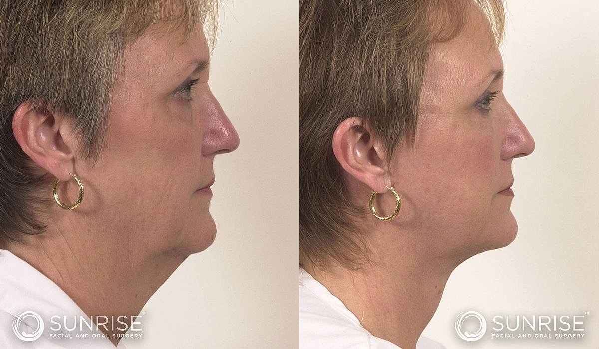 Necklift Before & After
