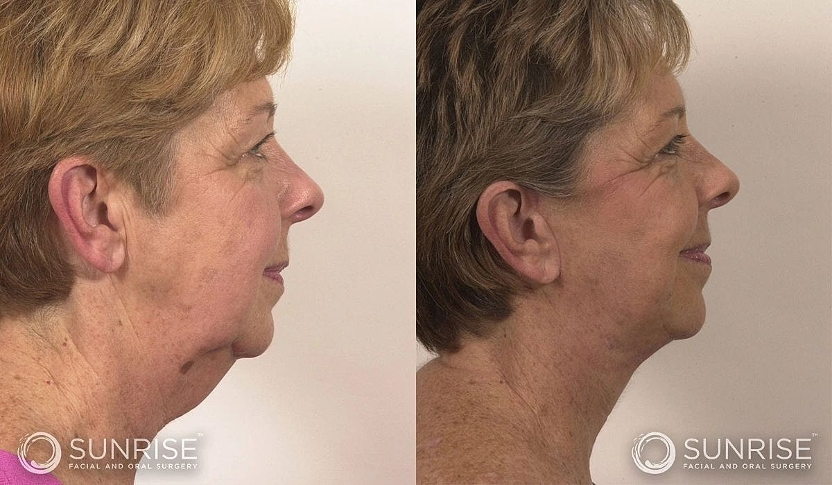 Necklift Before & After