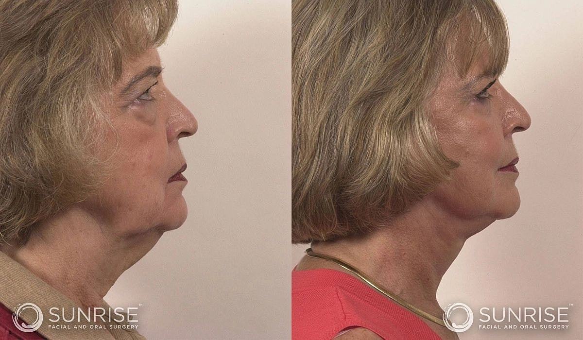 Necklift Before & After