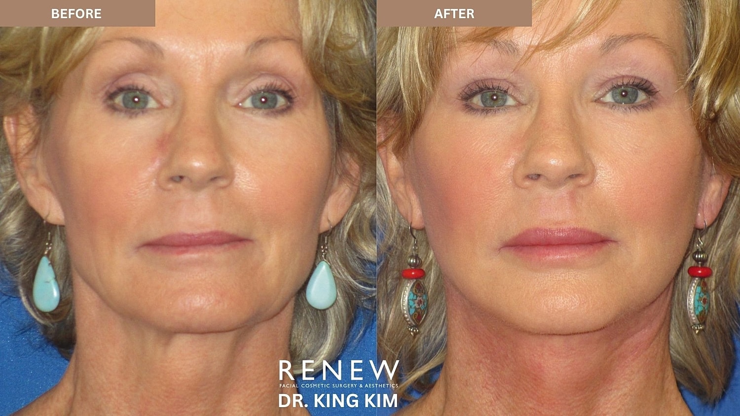 Abbreviated Facelift Before & After
