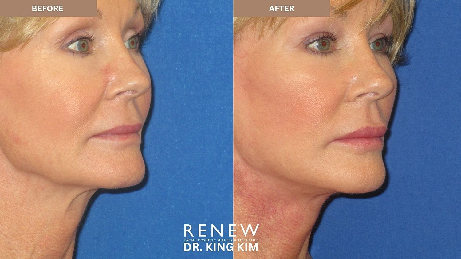 Abbreviated Facelift Before & After
