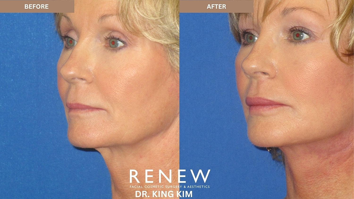 Abbreviated Facelift Before & After