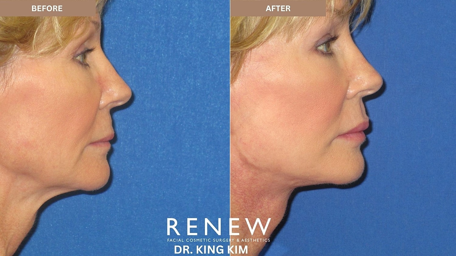 Abbreviated Facelift Before & After
