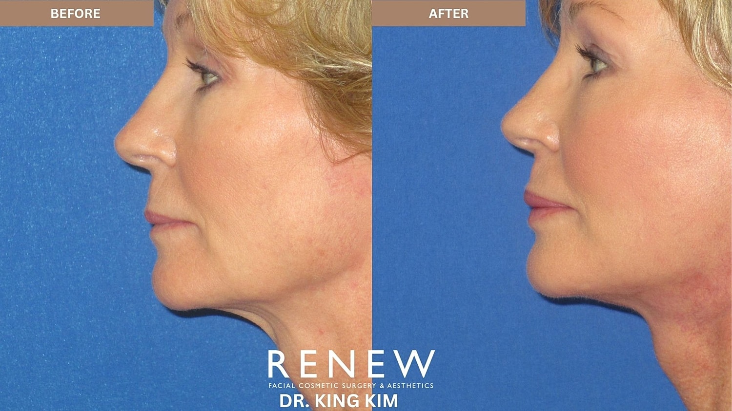Abbreviated Facelift Before & After