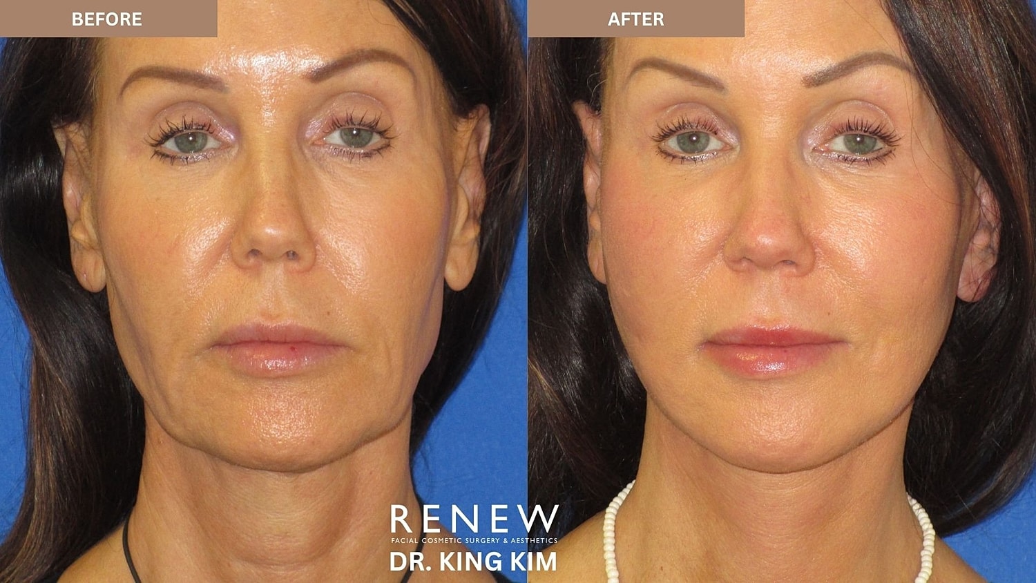Abbreviated Facelift Before & After
