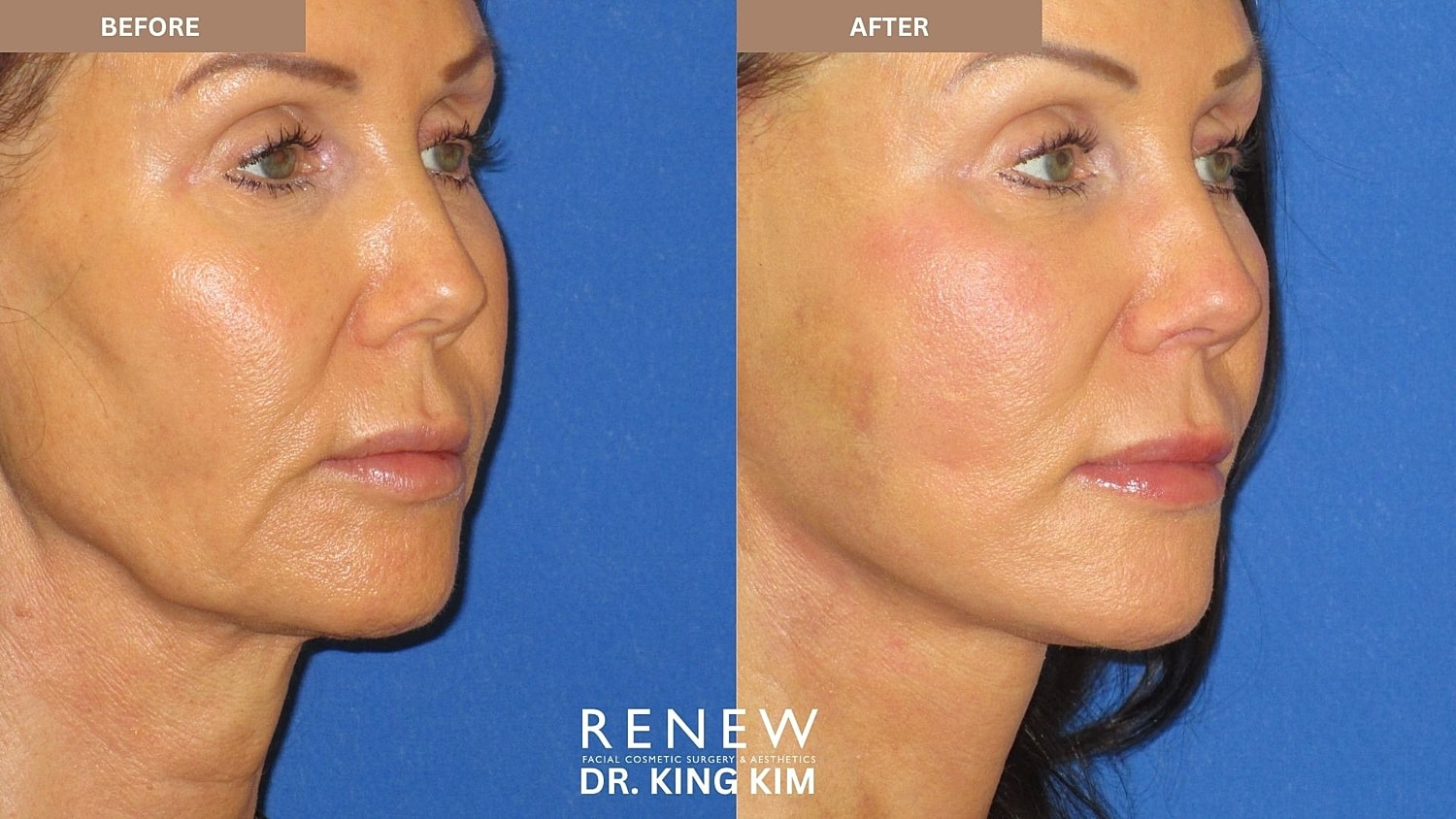 Abbreviated Facelift Before & After
