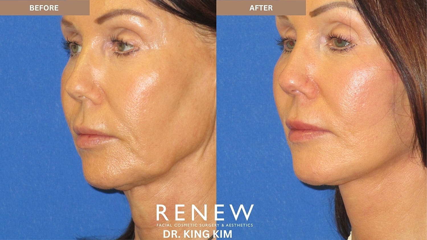 Abbreviated Facelift Before & After