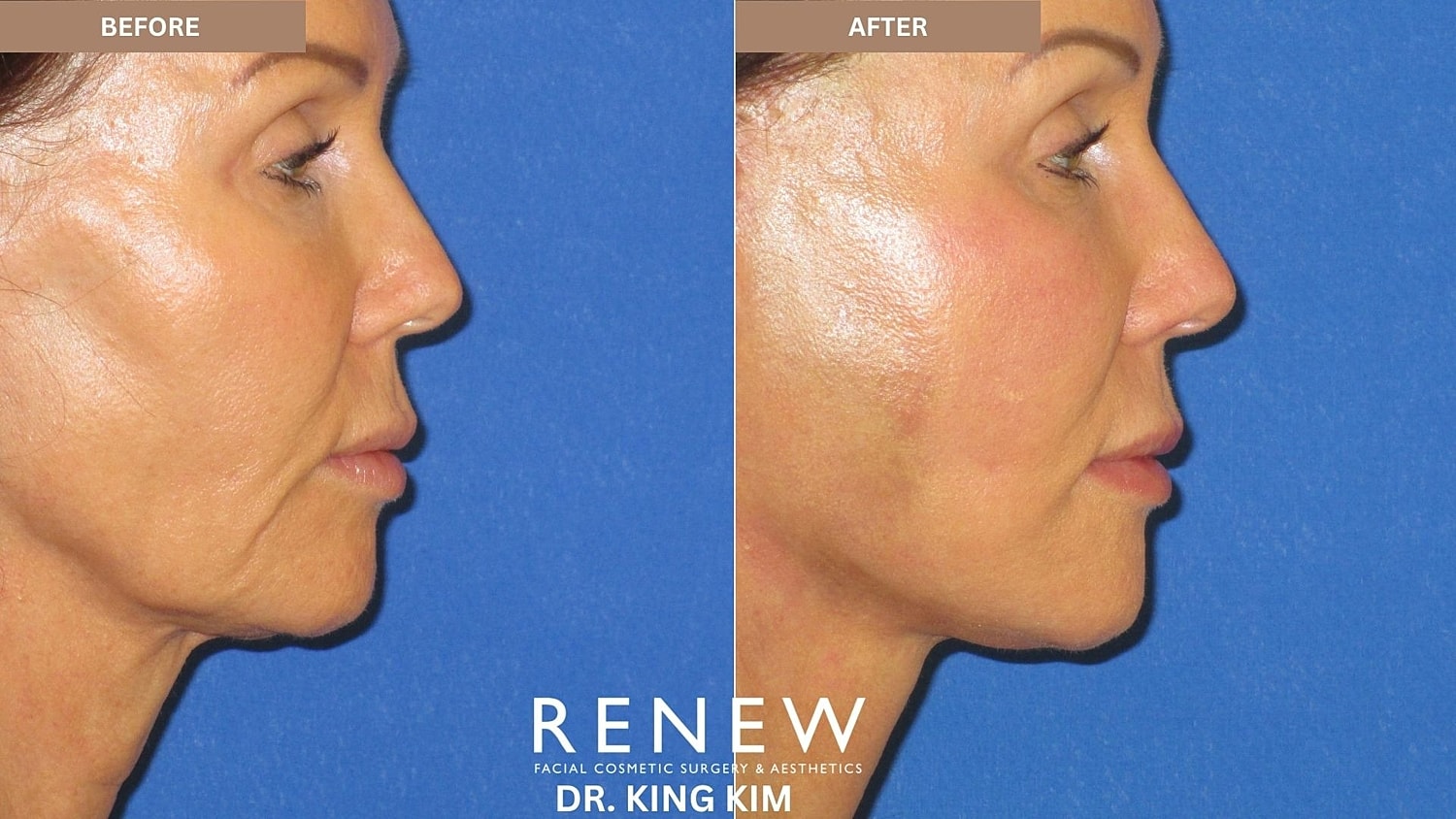 Abbreviated Facelift Before & After