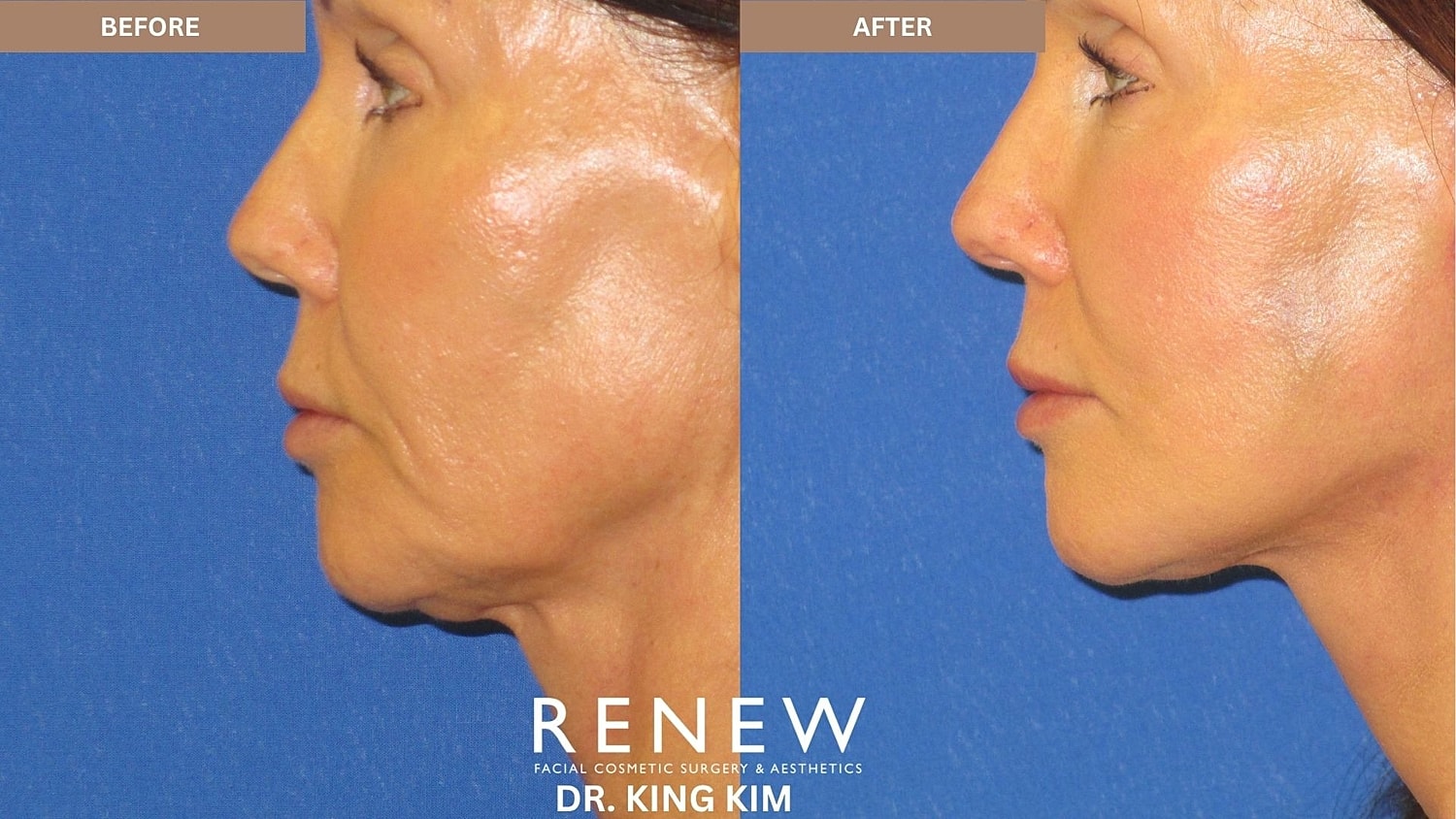 Abbreviated Facelift Before & After