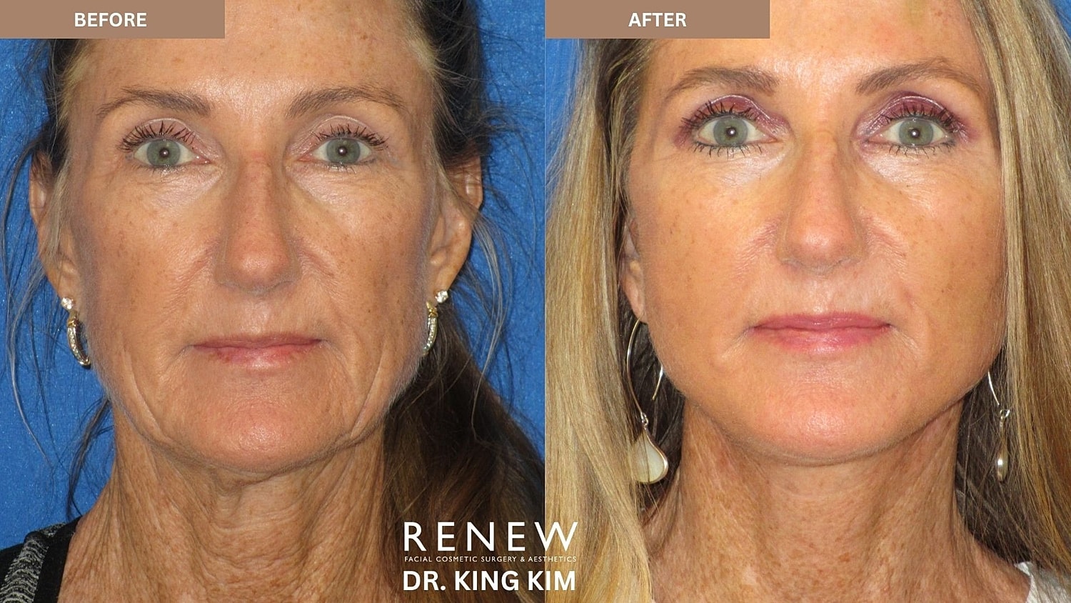Abbreviated Facelift Before & After