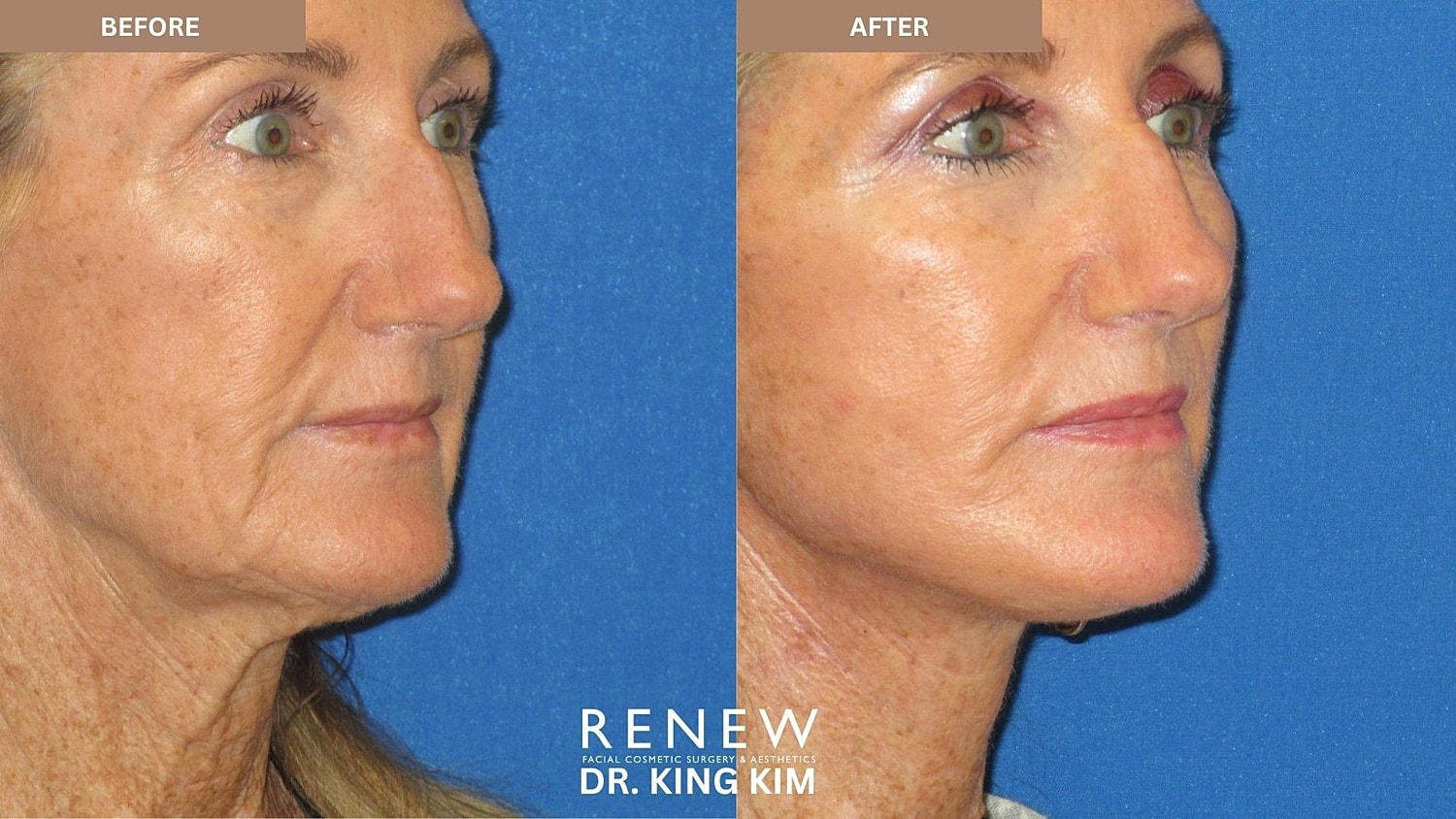 Abbreviated Facelift Before & After