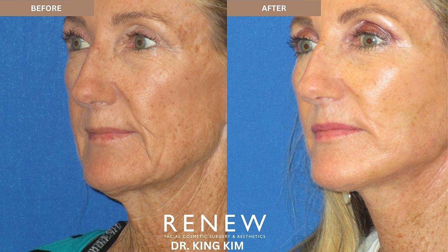 Abbreviated Facelift Before & After
