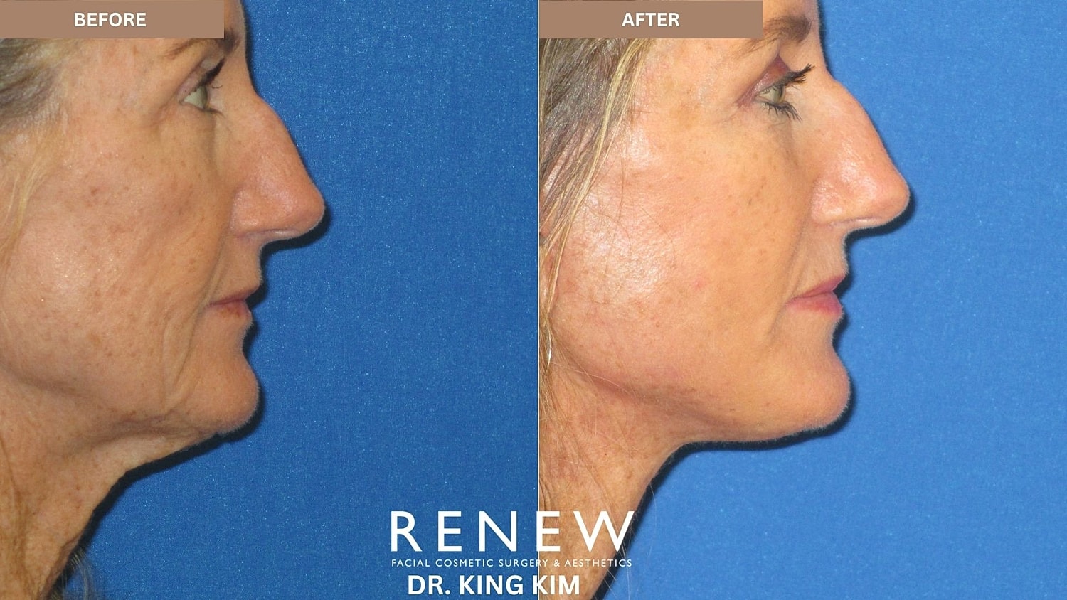 Abbreviated Facelift Before & After