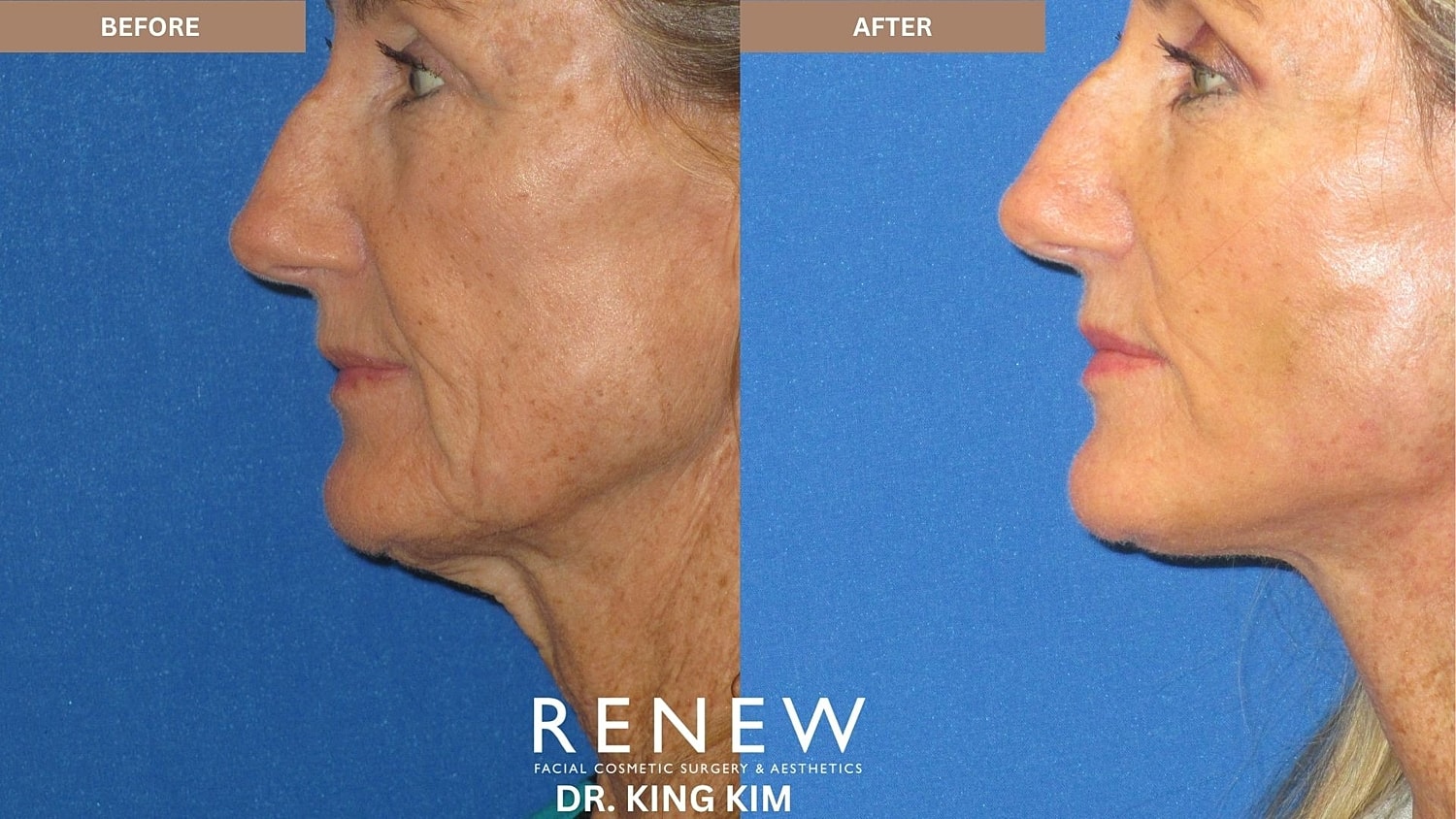 Abbreviated Facelift Before & After