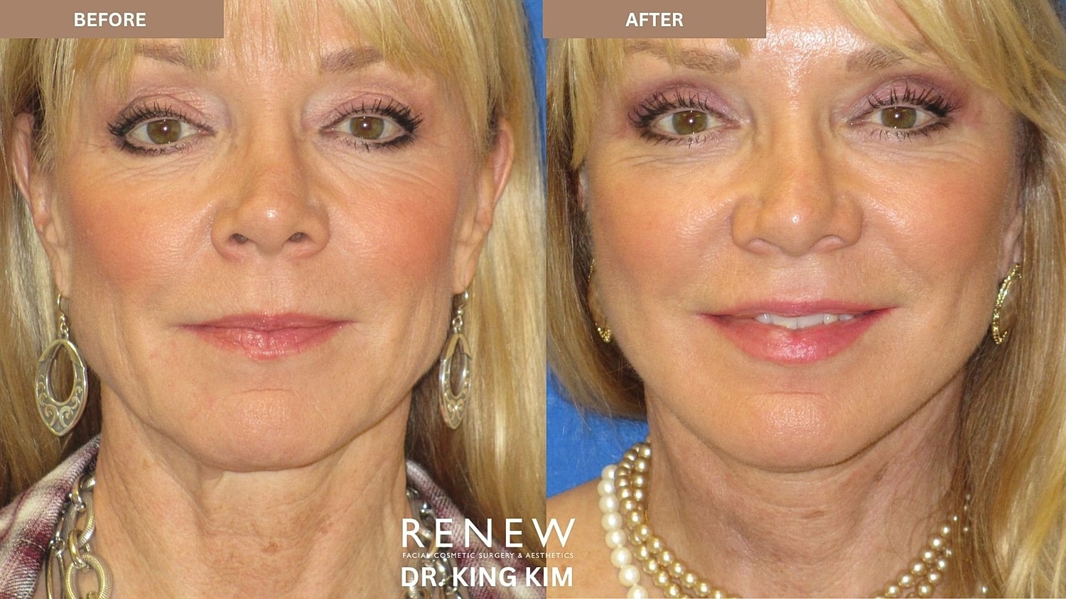 Abbreviated Facelift Before & After