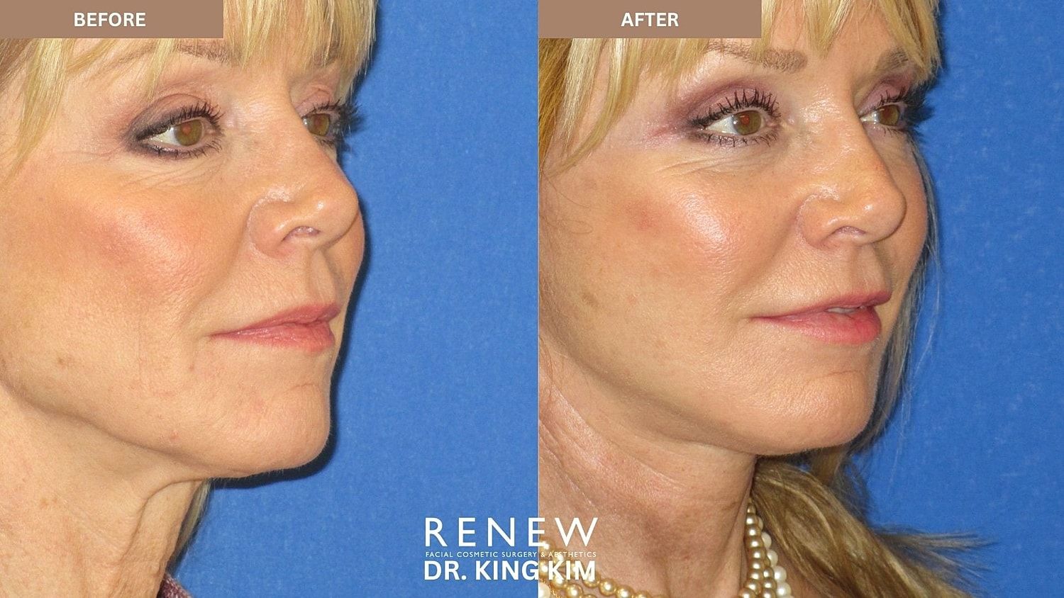 Abbreviated Facelift Before & After