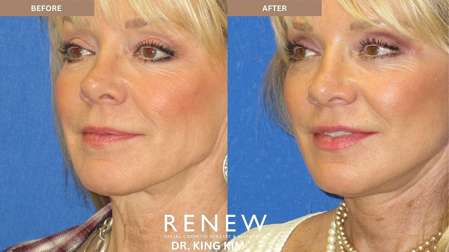 Abbreviated Facelift Before & After