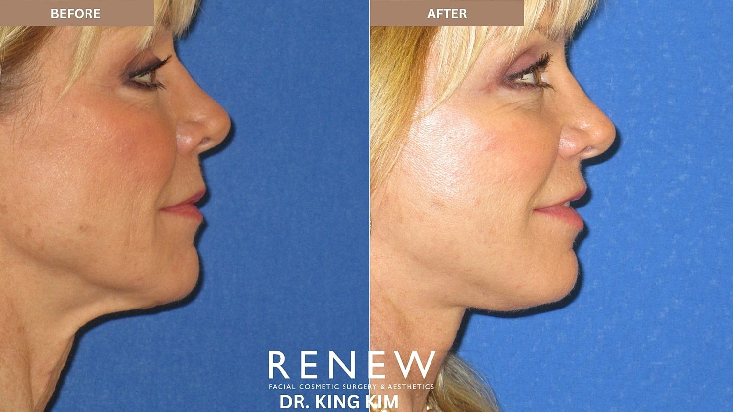 Abbreviated Facelift Before & After
