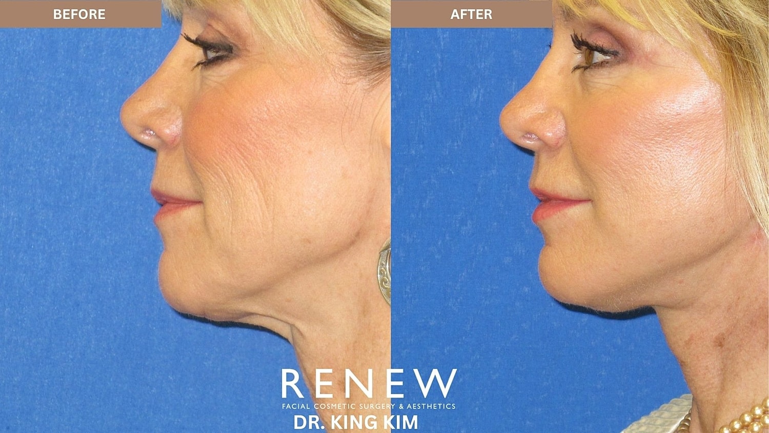 Abbreviated Facelift Before & After