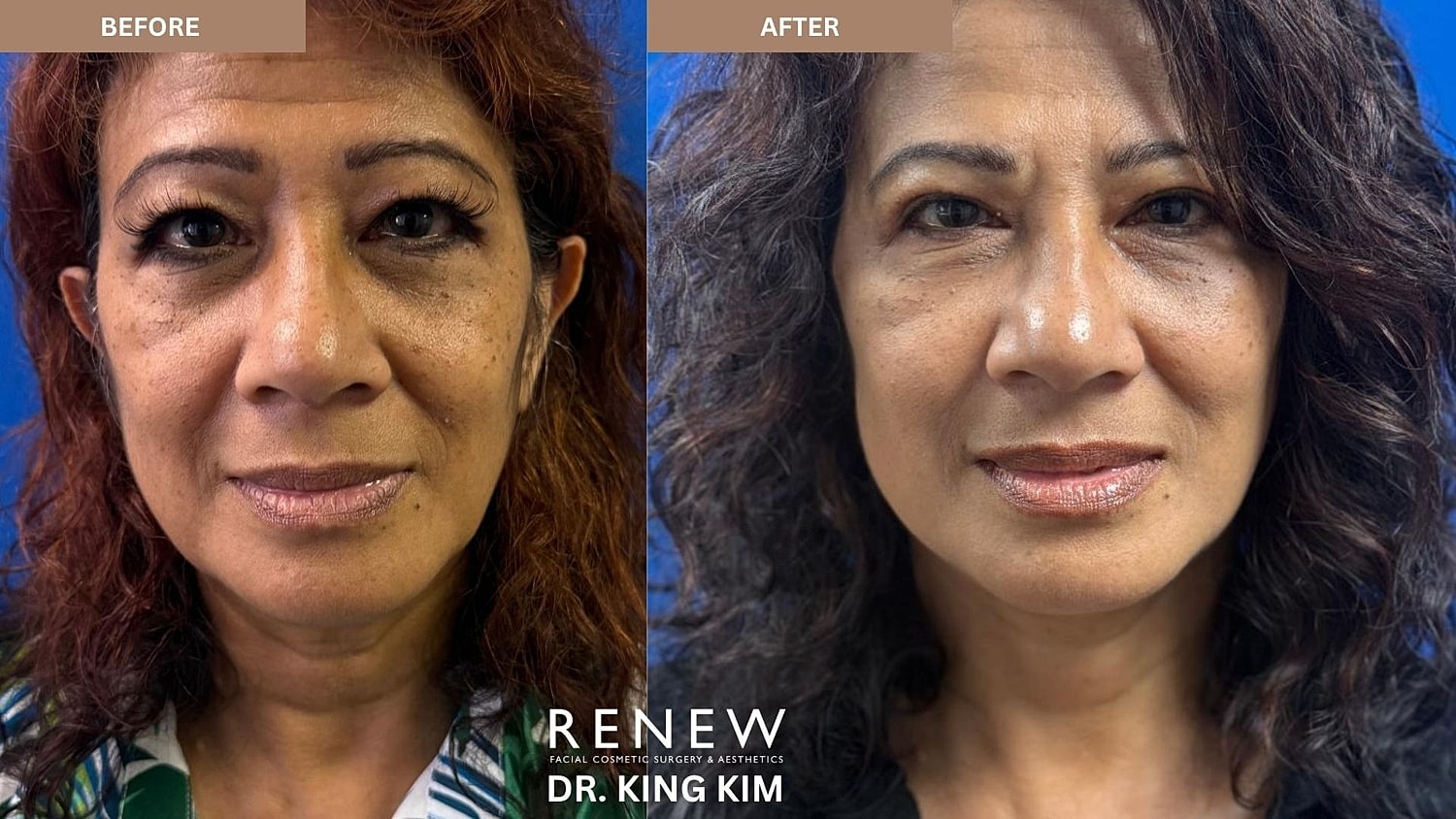 Abbreviated Facelift Before & After