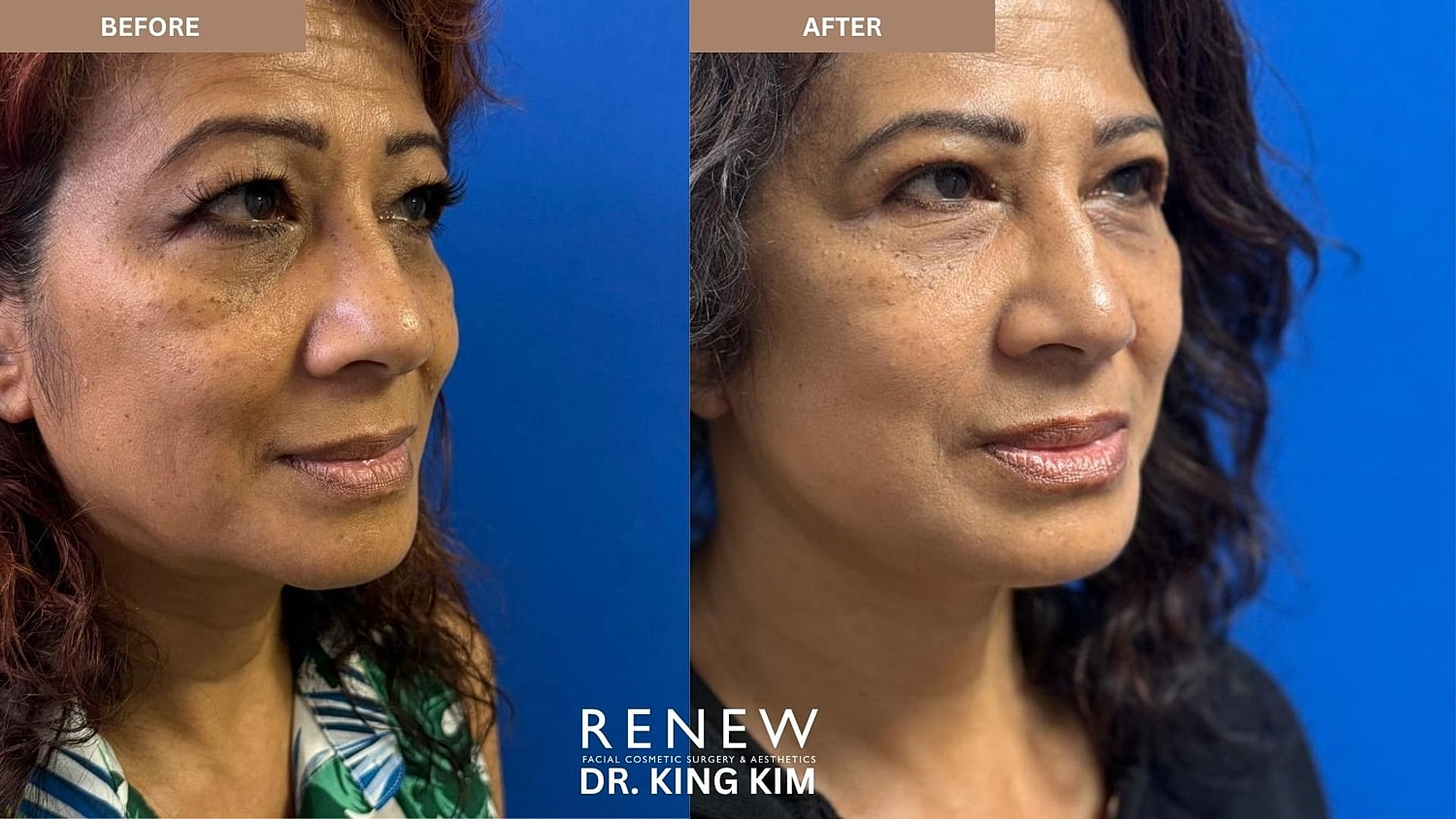 Abbreviated Facelift Before & After
