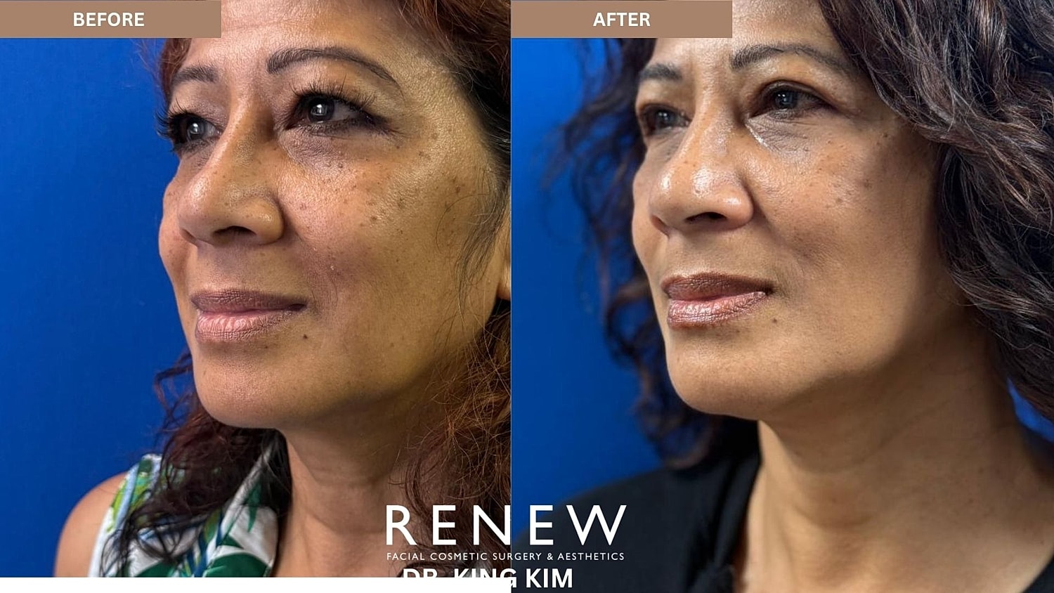Abbreviated Facelift Before & After