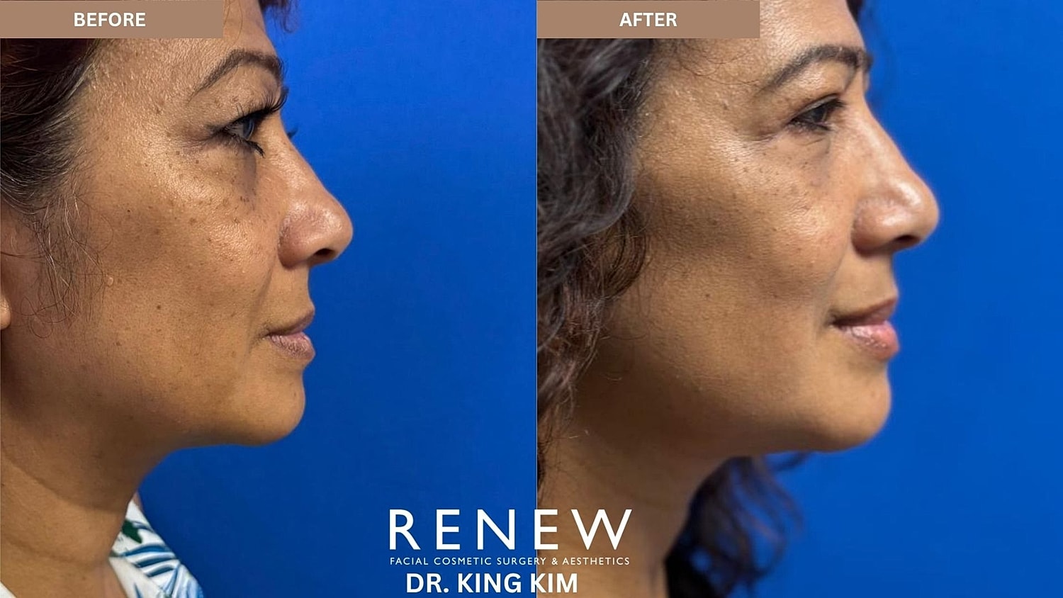 Abbreviated Facelift Before & After