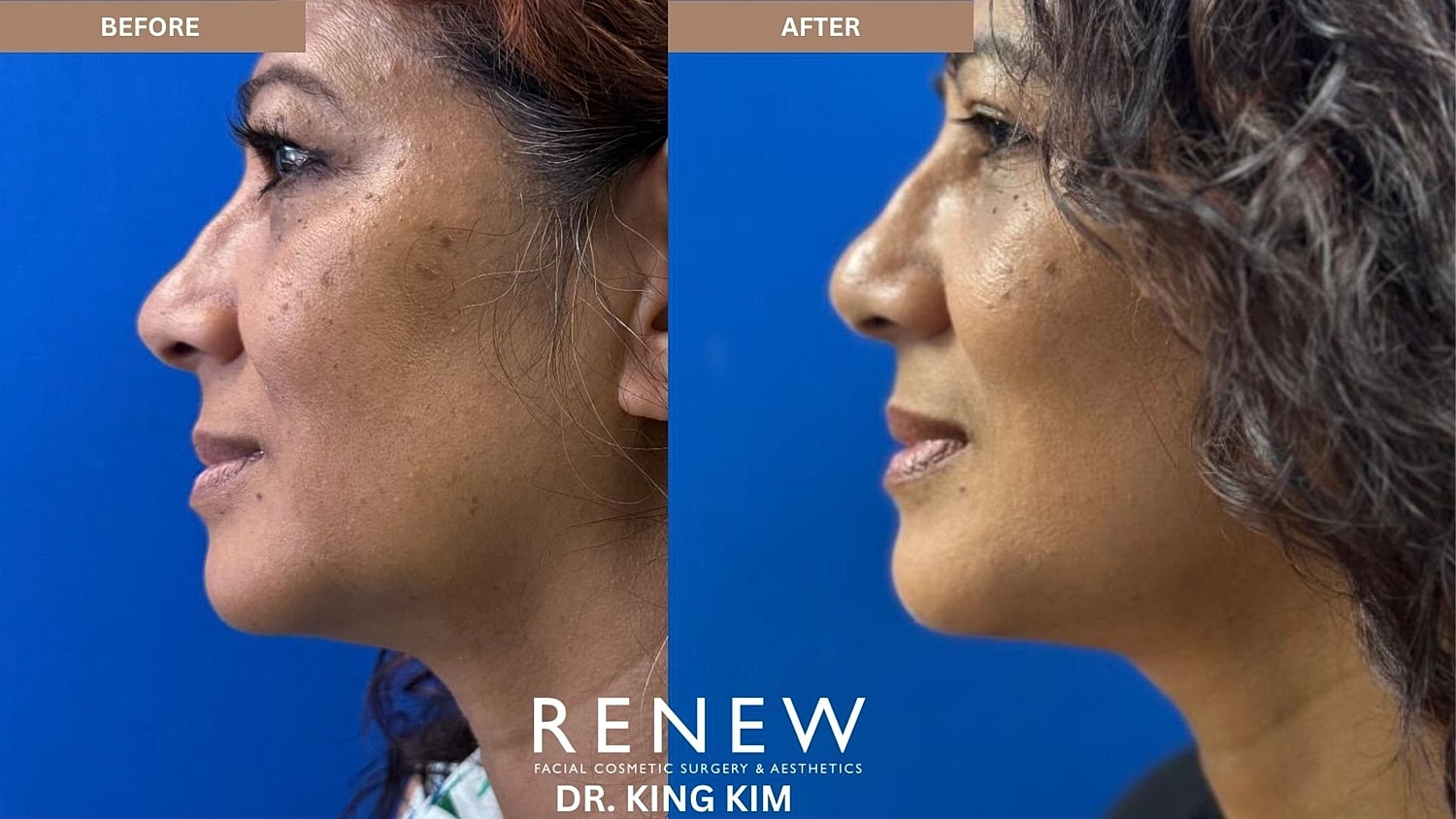 Abbreviated Facelift Before & After