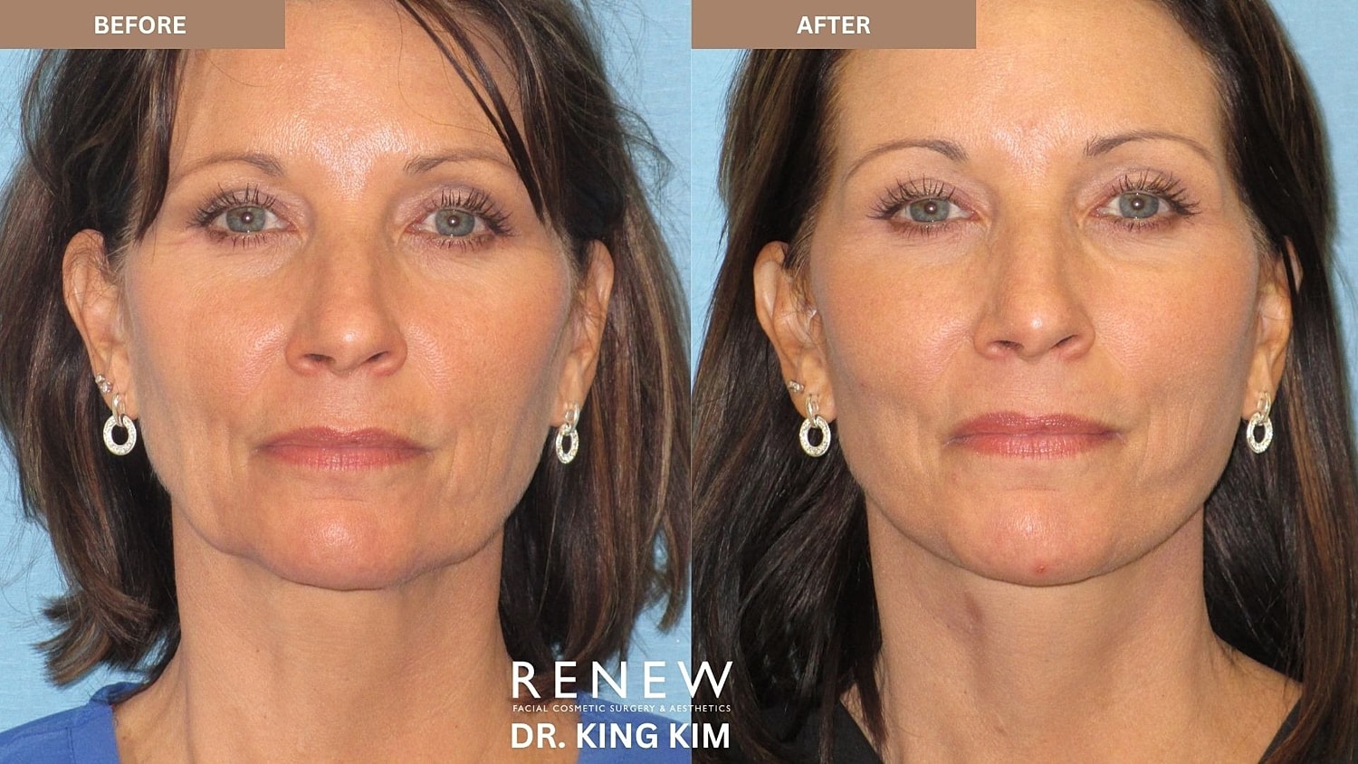 Abbreviated Facelift Before & After