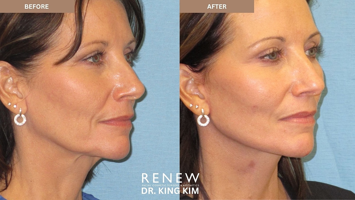 Abbreviated Facelift Before & After