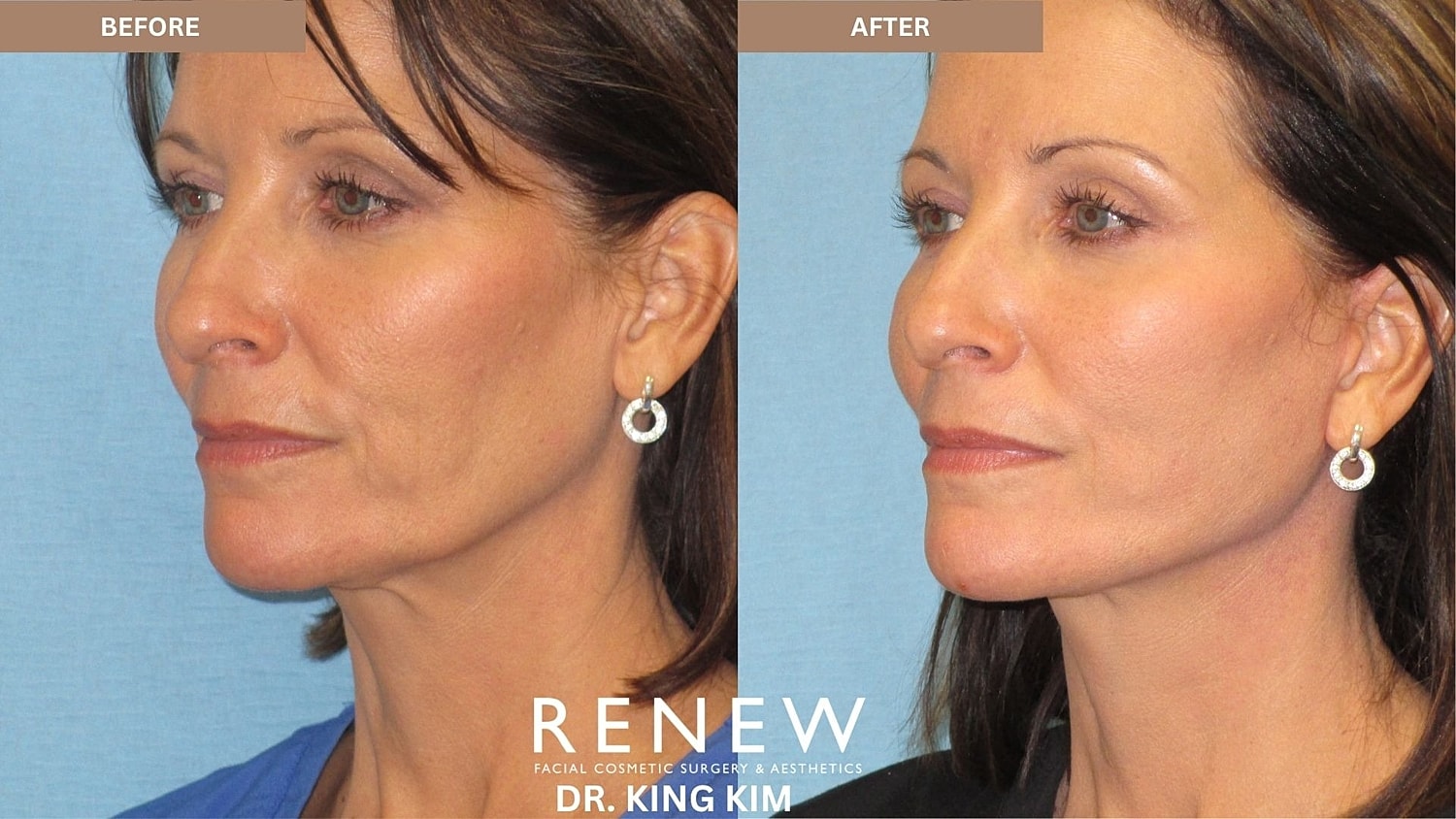 Abbreviated Facelift Before & After